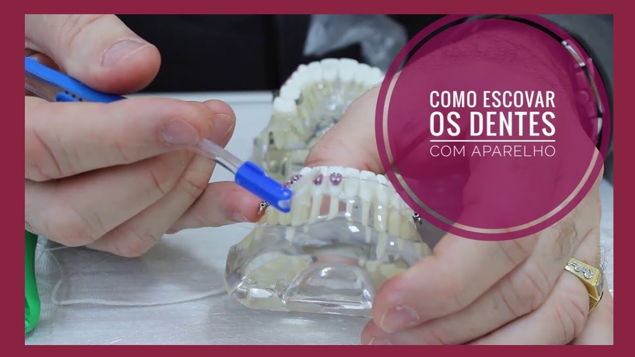 ESCOVAÇÃO DOS DENTES COM APARELHO - DR RENATO FERREIRA