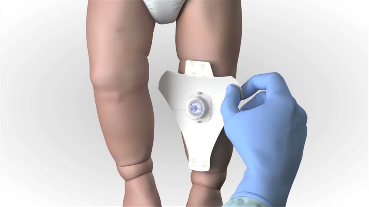 Arrow&reg; EZ IO&reg; System   Proximal Tibia Site Identification Insertion Infant Child, Animation