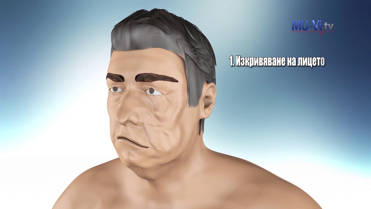 Инсулт. Времето е мозък / Stroke. Time is brain