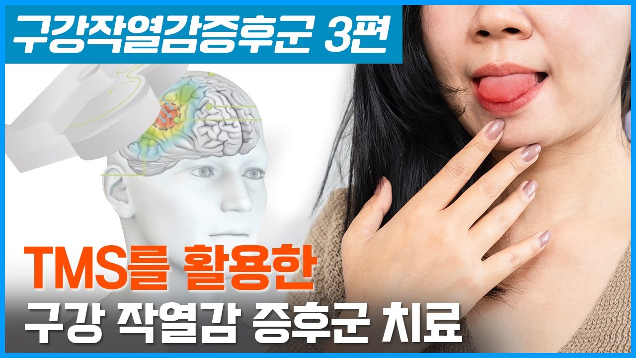 TMS를 활용한 구강작열감증후군 치료 - 3편