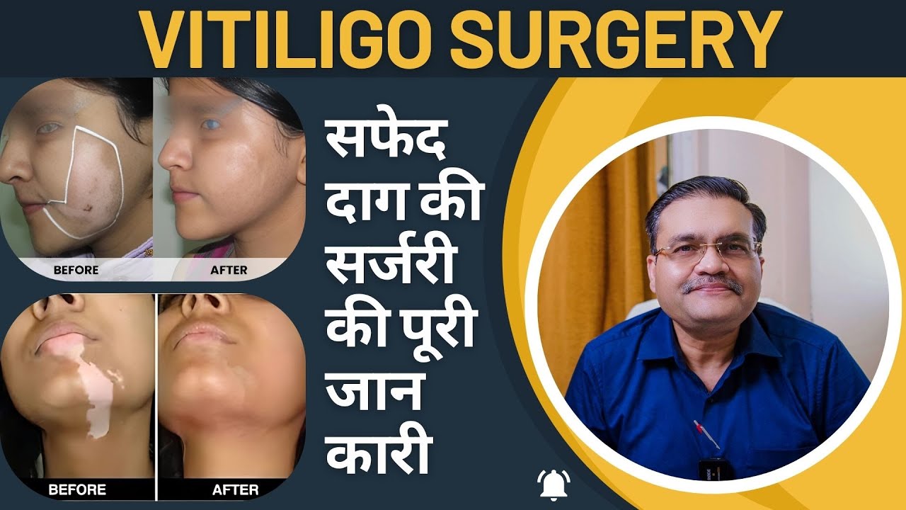 Vitiligo Surgery | सफेद दाग की सर्जरी का खर्च, तरीका और कितना समय लगता है – जानिए पूरी जानकारी