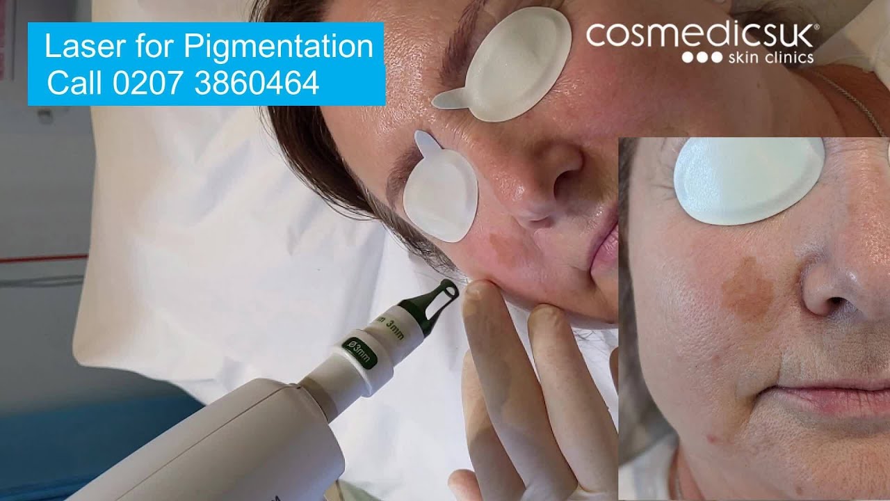 Laser for facial pigmentation & sun damage treatment demo - see before and after results