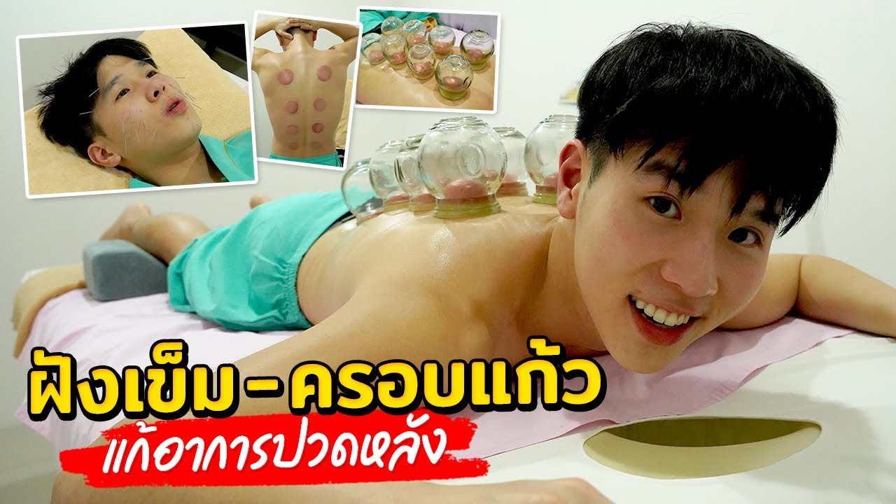 ฝังเข็ม ครอบแก้ว แก้อาหารปวดหลัง ออฟฟิศซินโดรม