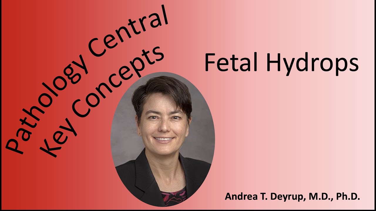 Medical School Pathology: Pathophysiology of Fetal Hydrops