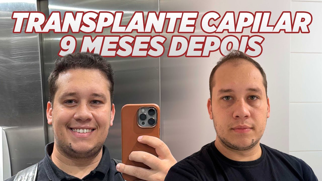 9 MESES DE TRANSPLANTE CAPILAR 5 MIL FOLÍCULOS - 8th hair transplant 5k grafts