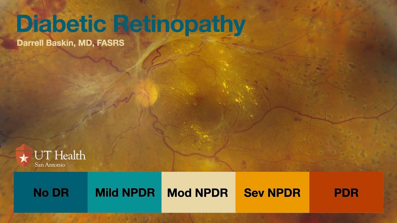 Diabetes and the Retina 2024