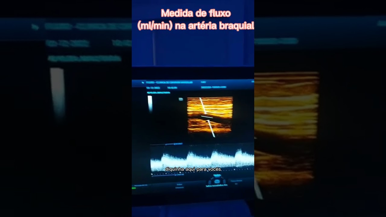 Doppler de Fístula Bráquio-basílica - Ao vivo