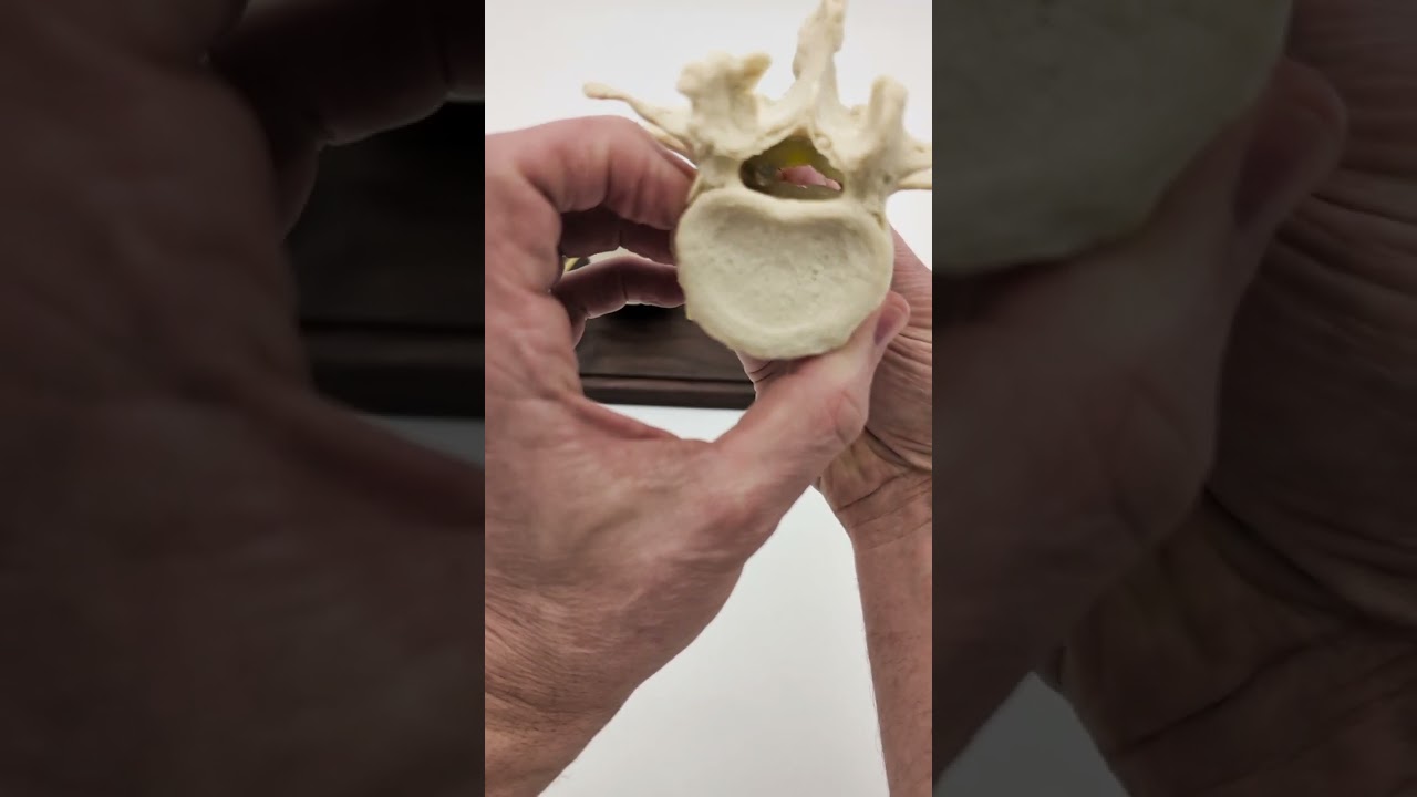 Lumbar Spinal Stenosis in Motion | Central, Lateral & Lateral Recess Stenosis
