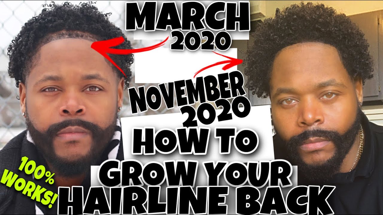 How I GREW MY HAIRLINE Back Super FAST!! 100% WORKS!!