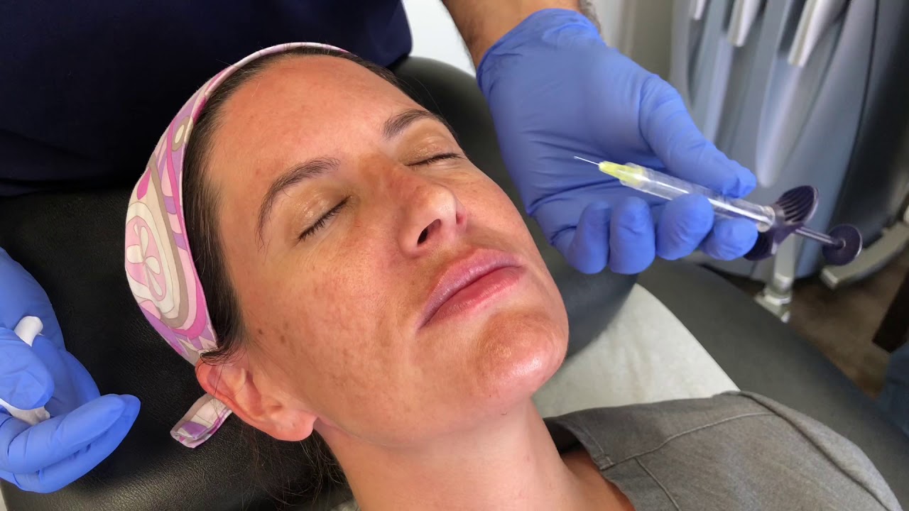 New Restylane Kysse Lip Filler - Dr. Mark Youssef Demonstrates Our Exciting New Lip Filler