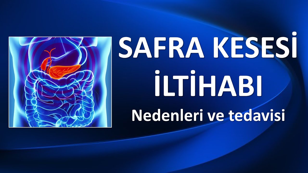 SAFRA KESESİ İLTİHABI TEŞHİS VE TEDAVİSİ