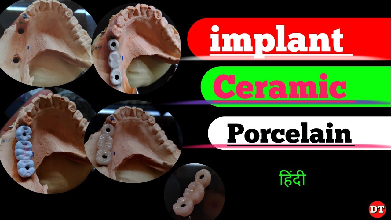 Implant Ceramic porcelain|| canstable implant|| Pfm| Anatomy| Human Tooth| ceramic build up| implant