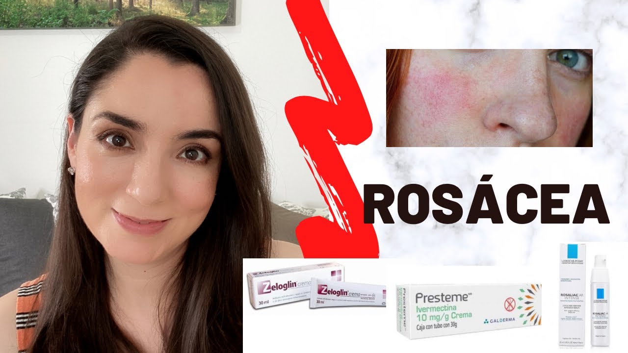Rosácea, mi tratamiento y experiencia