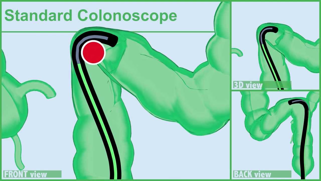 COLONSCOPY: Segment by Segment (5/03)