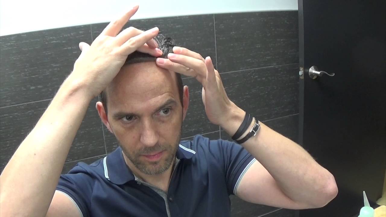 Glue or tape removal and cleaning of front hairline on system