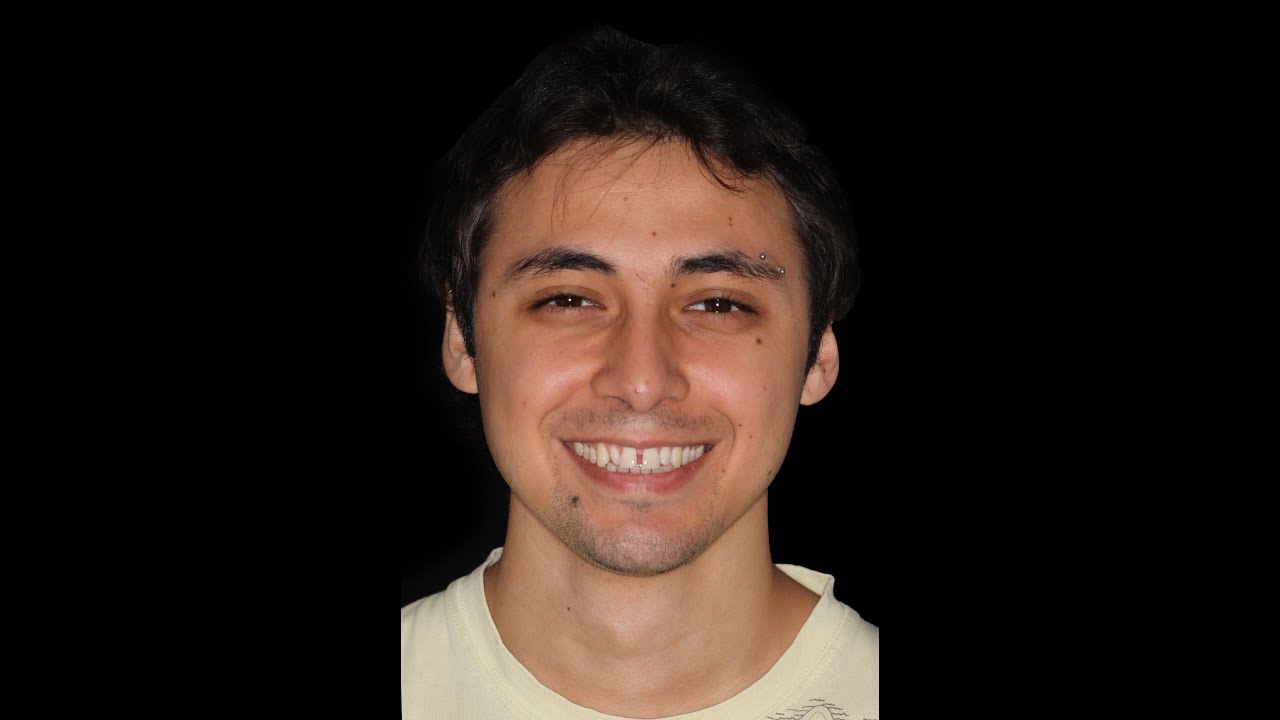 ✨ Diseño de Sonrisa: ¡Adiós Diastema! Caso Paciente Dr. Ariel Merino