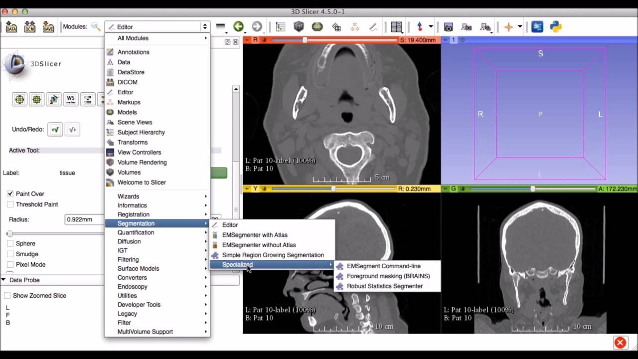 Robust Statistics Segmenter (RSS) Tutorial Video for  Mandibular Segmentation