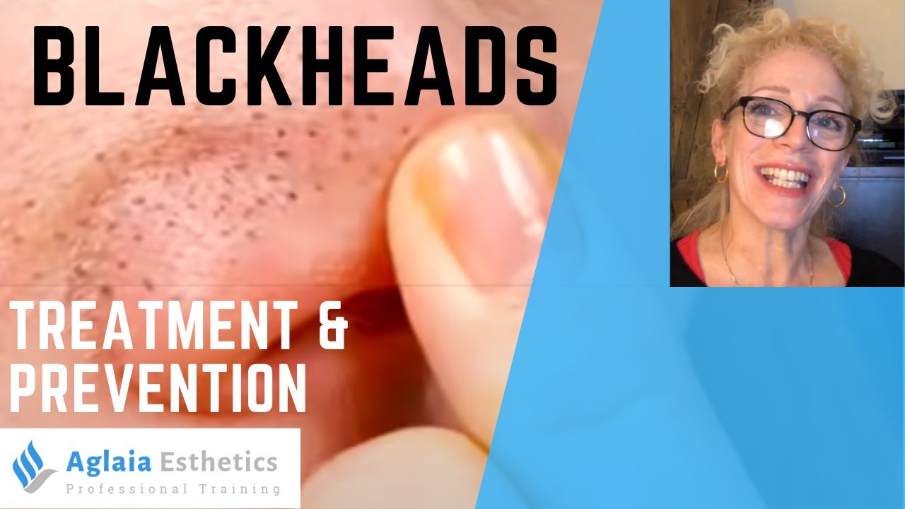 HOW TO GET RID OF BLACKHEADS FAST AT HOME!