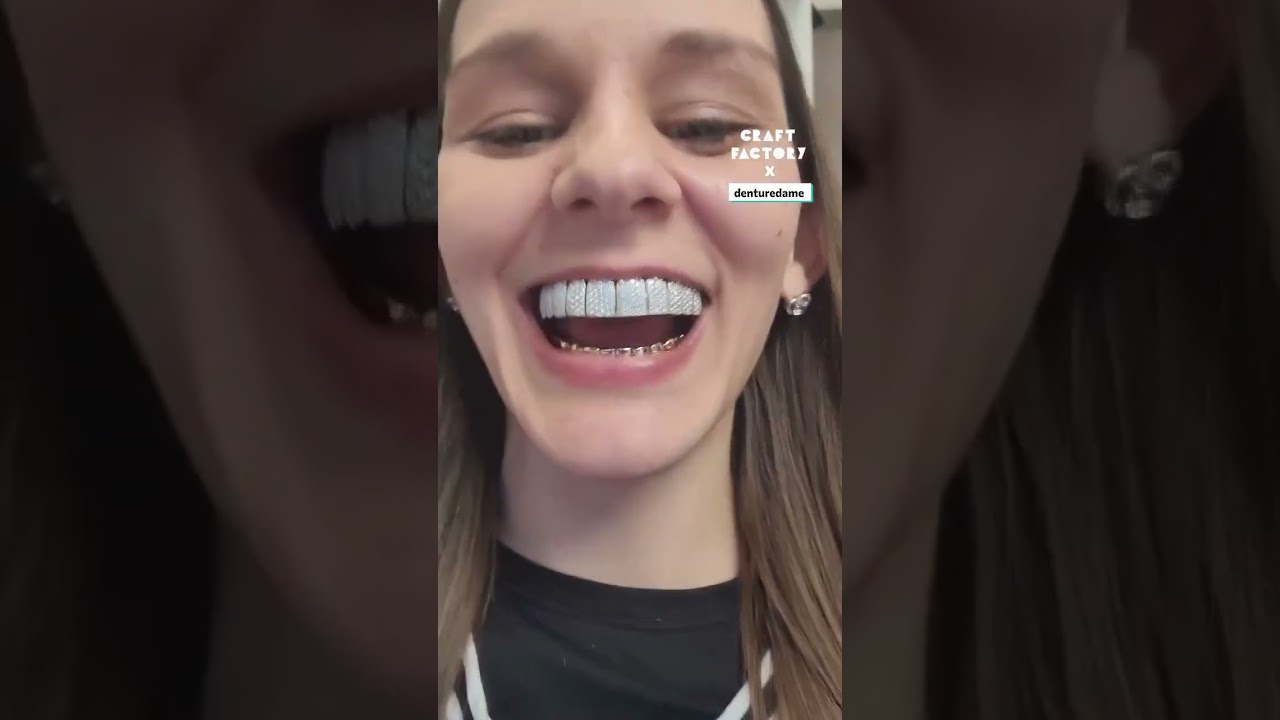 Getting Diamond Grillz After Losing My Teeth 🦷💛 #grillz #veneers #teeth @denturedame