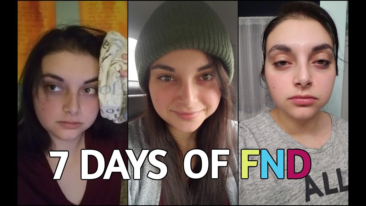 One Week of Functional Neurological Disorder | Mayo Clinic News! (Warning: Graphic Content)