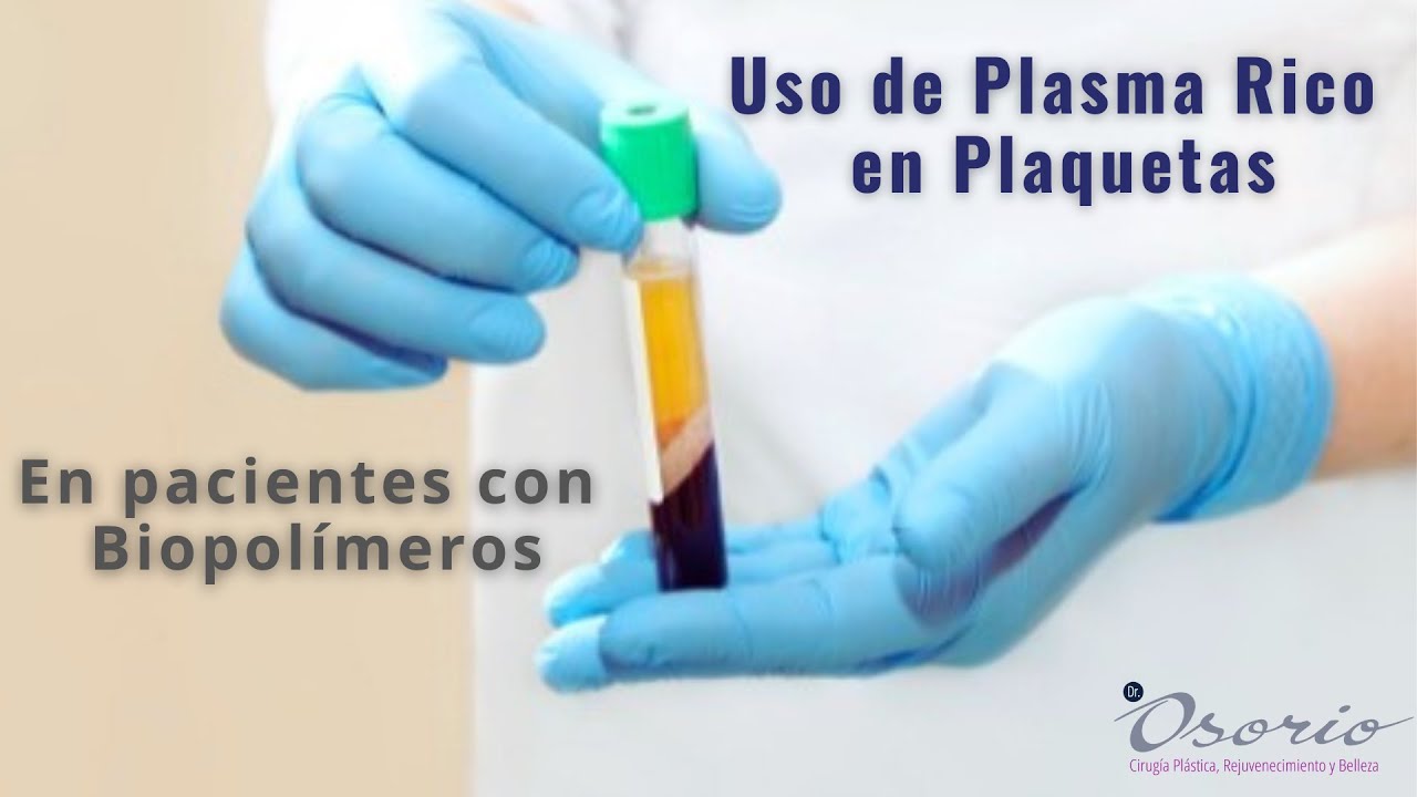 Plasma Rico en Plaquetas en pacientes con biopolímeros