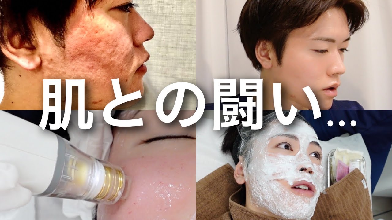 ポテンツァで『毛穴 クレーター』を治す！【スキンケアガチ勢の日常】