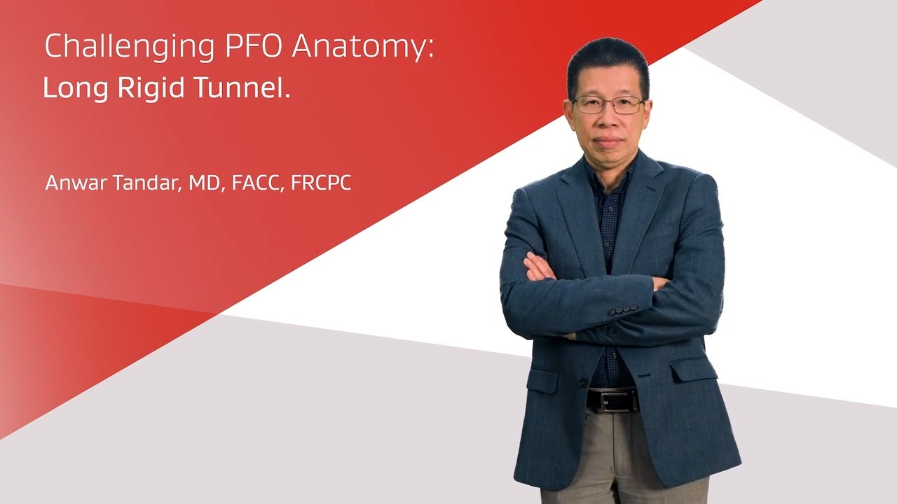 Tandar Video: Complex case long, rigid tunnel