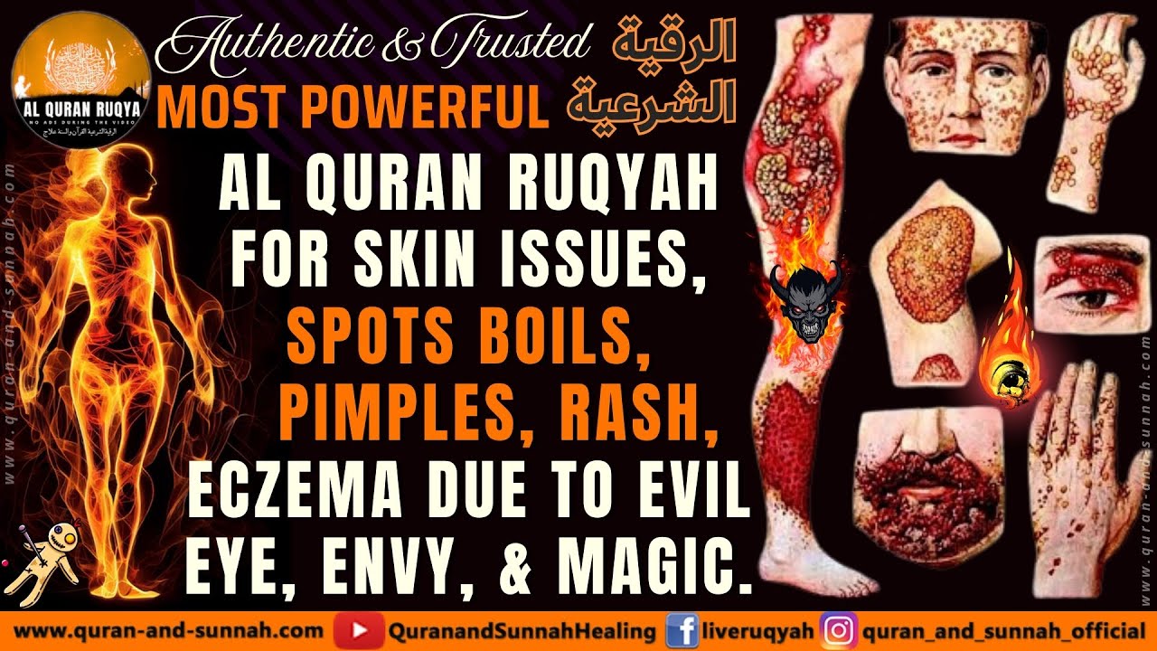 Al Quran Ruqyah For Skin Issues, Spots Boils, Pimples, Rash, Eczema Due To Evil Eye, Envy, & Magic.