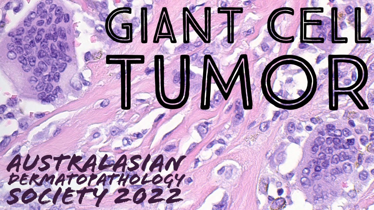 Giant cell tumor of tendon sheath 101 pathology