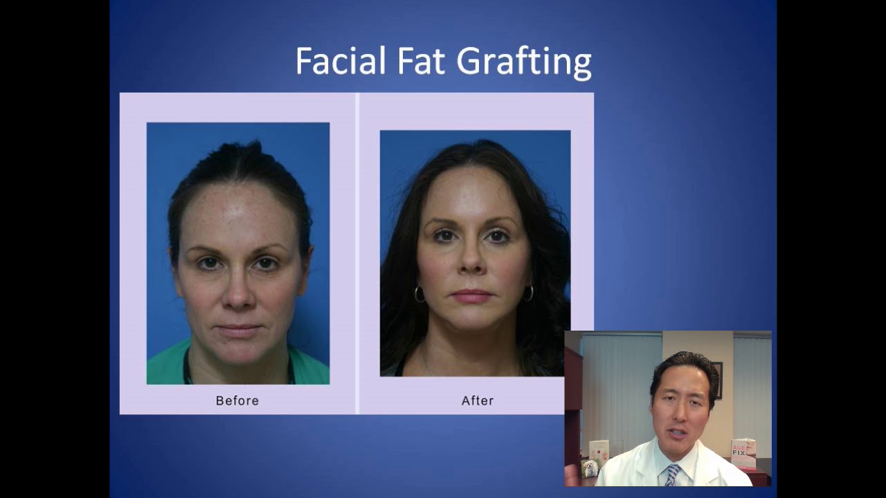 How Do I Add Volume to My Cheeks - Facial Fat Grafting Consultation - Dr. Anthony Youn