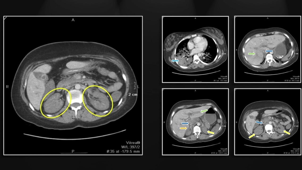Renal Infections | Interesting Radiology Cases