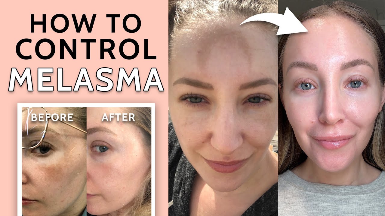 How I Control My Melasma
