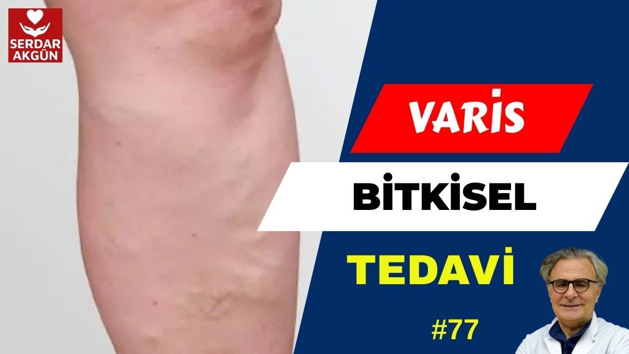 77. Varis İçin Bitkisel, Çözümler, Doğal Çözümler, Serdar Akgün, Varis Tedavisi
