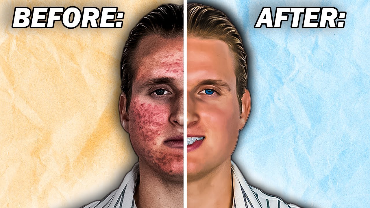 Acne Almost Ruined My Life, but then…