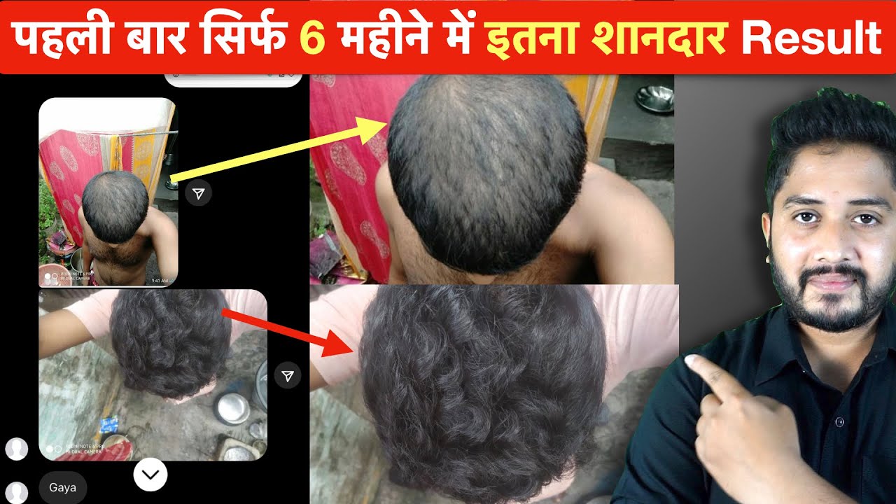 पहली बार सिर्फ 6 महीने में इतना शानदार Result || Hair Regrowth Result in 6 Months.