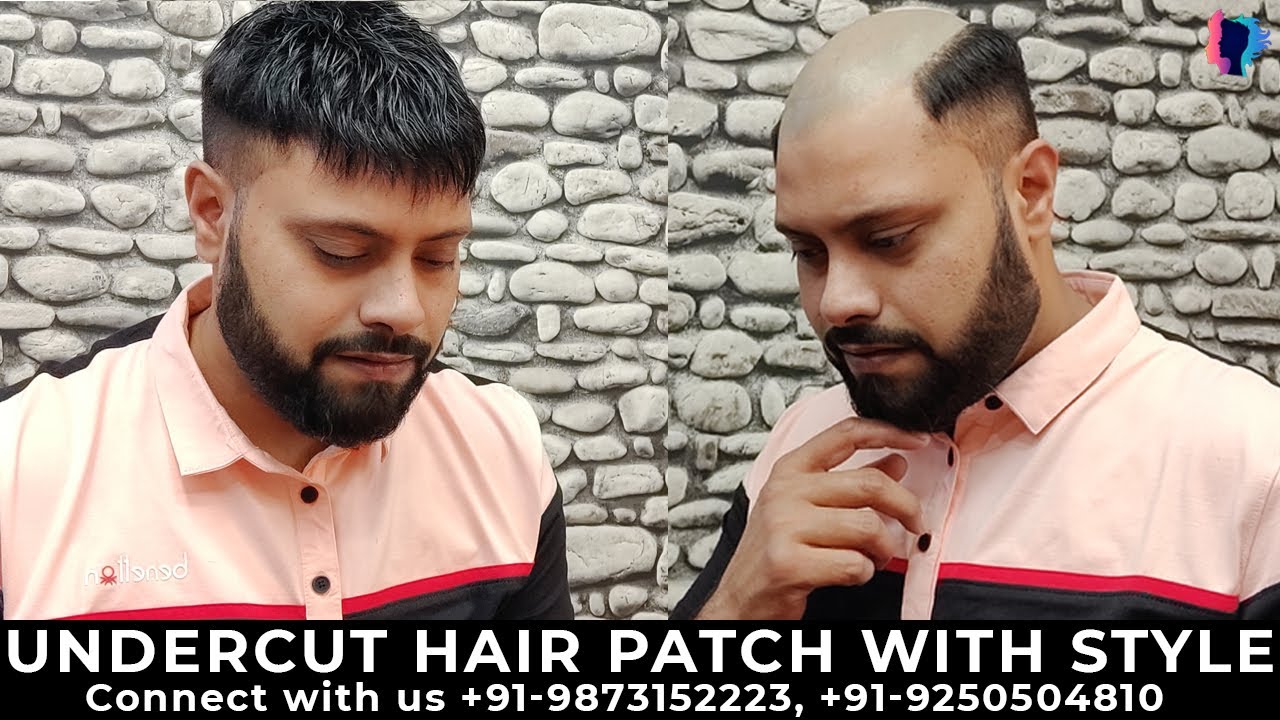 Mens Undercut Hairstyle | Best Hair Patch Style | Permanent Hair Patch #hairpatch