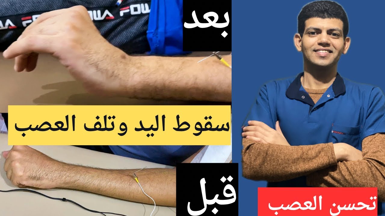 التحسن الكامل للعصب الكعبرى/كسر عظمة الذراع