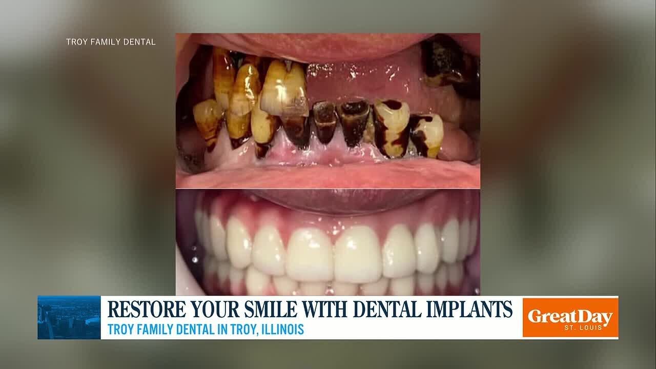 Restore Your Smile with Dental Implants