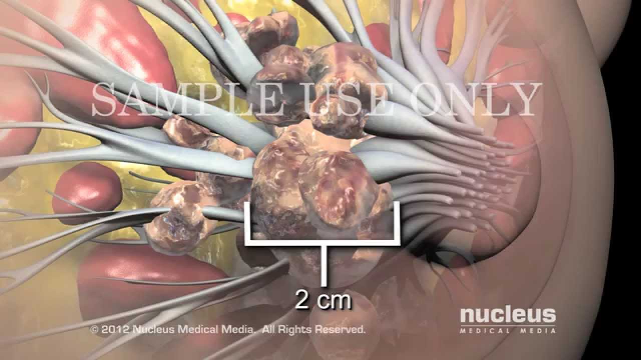 Progreso y estadificación del cáncer de mama