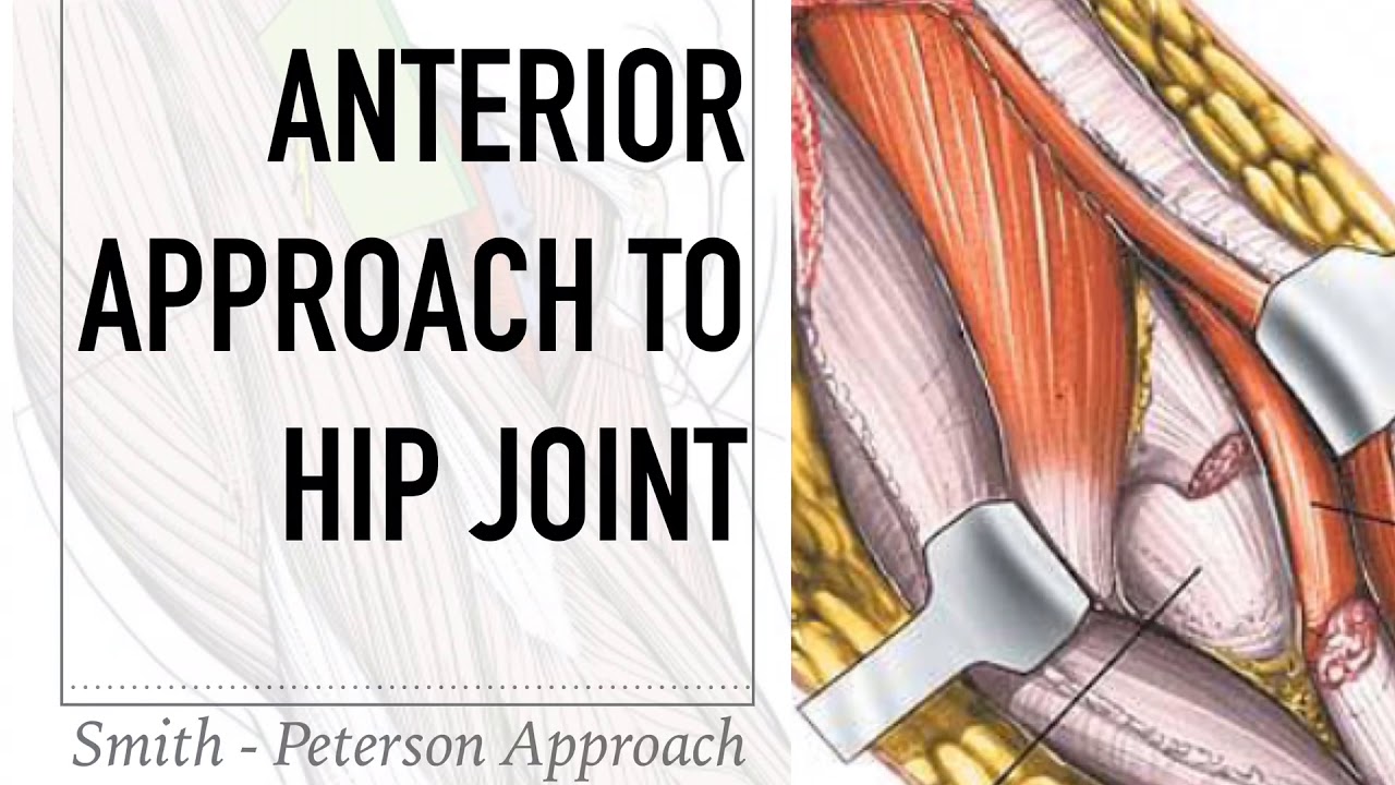 Anterior Surgical Approach to Hip joint  (Smith Peterson Approach)