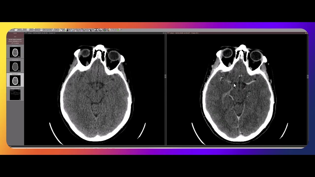 Comment interpréter un scanner cérébral ?