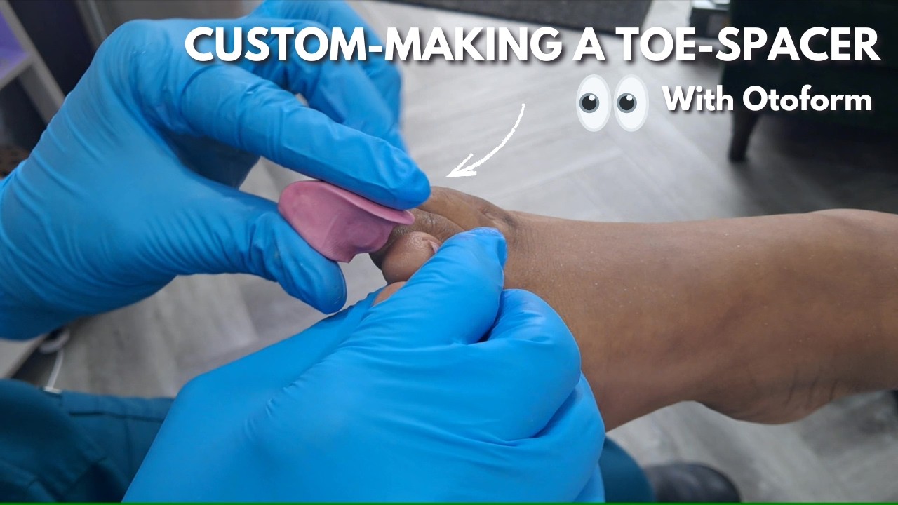 Watch me custom-make a toe separator with Otoform | Foot Health Practitioner, Not A Pod. UK