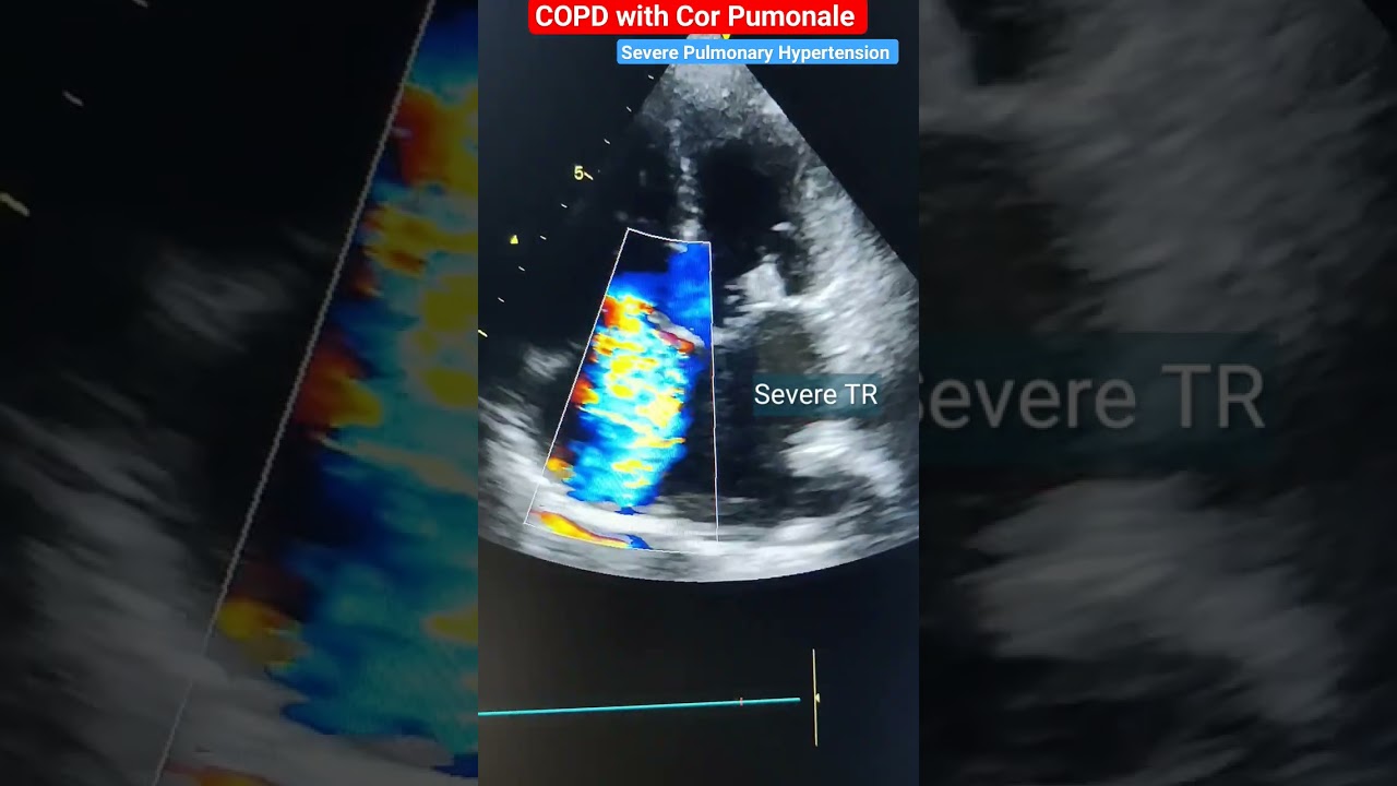 Severe TR (Tricuspid Regurgitation)  Echo l #echo #heart #shorts