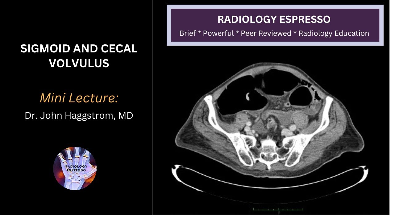 SIGMOID AND CECAL VOLVULUS: Mini Lecture, Dr. John Haggstrom, MD
