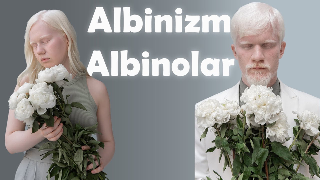 Albinos insanlar | Albinizm nədir? | Albinoslar haqqında məlumat | Fosfor adamlar | Ağ adamlar