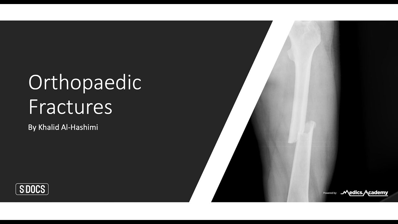 S|Docs Clinical: Do you know your upper limb fractures? (Orthopaedic Fractures Part 2)