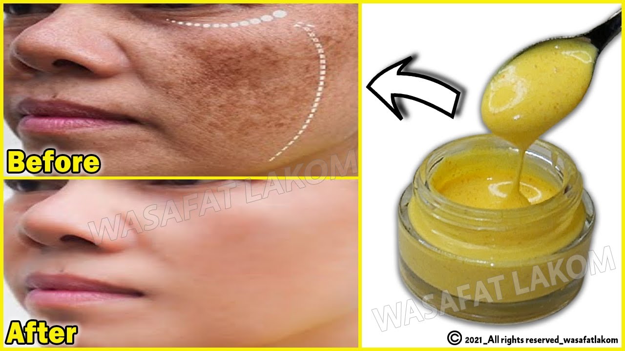 Magical Turmeric Cream | In 3 days it removes pigmentation, dark spots, freckles and treats melasma