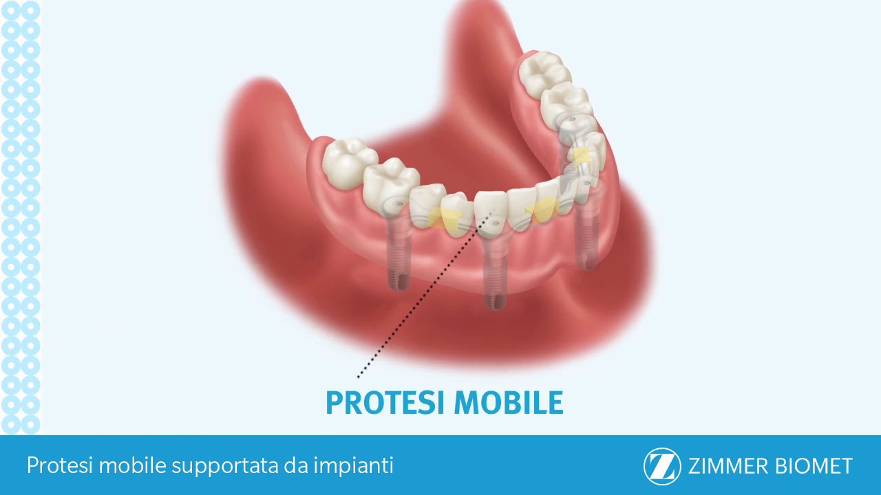 Protesi mobile supportata da impianti - Italian