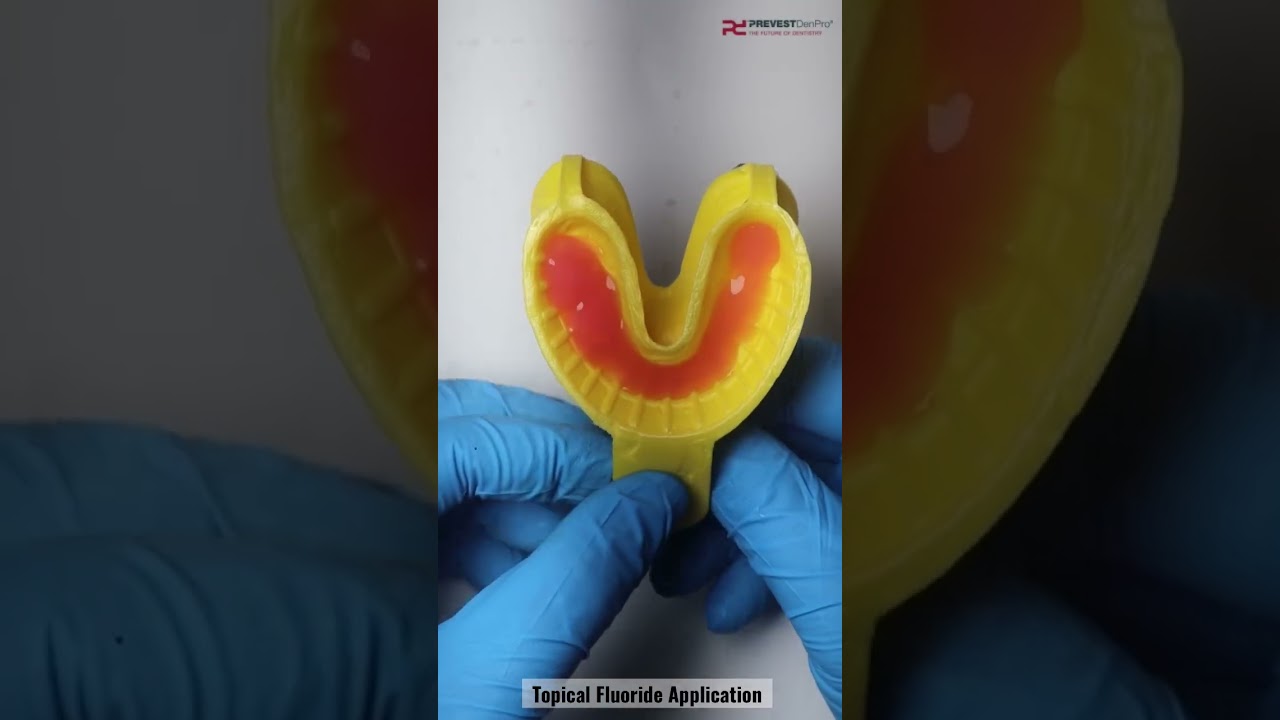 Topical Fluoride Application #prevestdenpro #atozkidsdental #fluoride