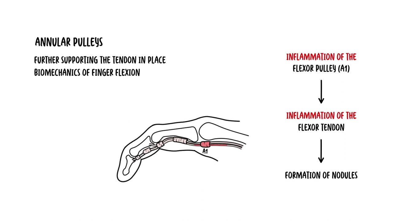 What is a Trigger Finger?
